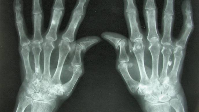 Rheumatoid Arthritis Patients Experience Cardiovascular Benefits from Statins