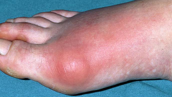 Treat-to-SU-Target Strategy May Slow, Prevent Bone Erosion