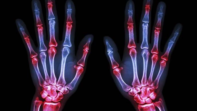 Higher Prevalence of Arthritis Among US Adults