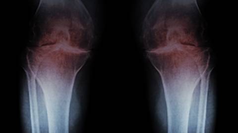 Osteoarthritis: Not Just a Wear-and-Tear Problem