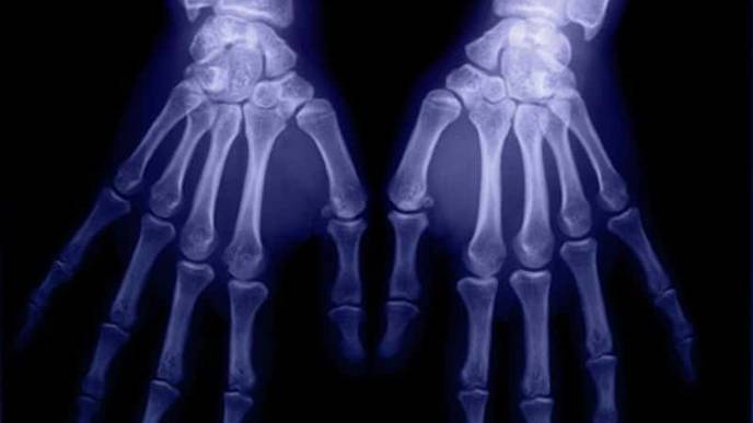 Common Sites of Bone Erosion in Rheumatoid Arthritis ID’d on Ultrasound