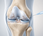 prp plus hyaluronic acid vs crosslinked hya in knee osteoarthritis