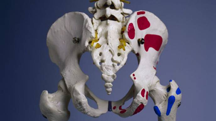 Partial Hip Replacement May Be Better Than Total Replacement, Study Suggests
