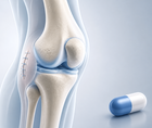 preoperative nonopioid analgesia lowers opioid use after arthroscopy