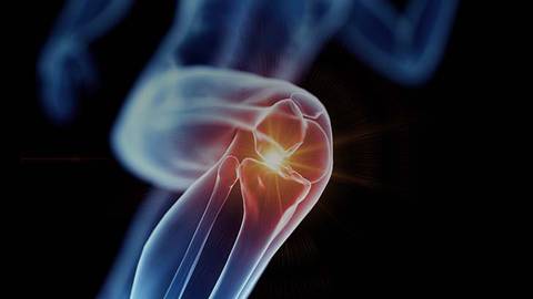 IBD-Associated Arthritis: A Guide for Gastroenterologists & Rheumatologists