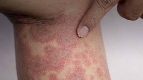 Examining the Role of Biologics in the Treatment of Lupus