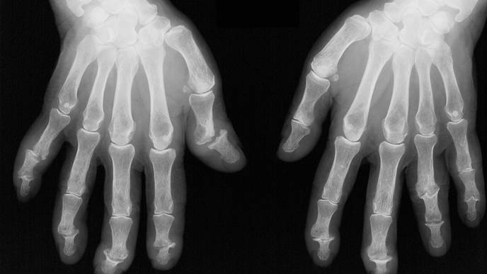 Comparing Physician & Patient Reports of Psoriatic Arthritis Remission