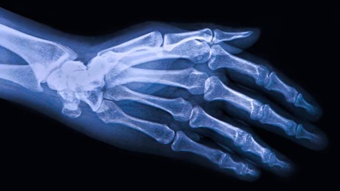 Prescription Opioids Are Used Long-Term to Treat Severe Osteoarthritis