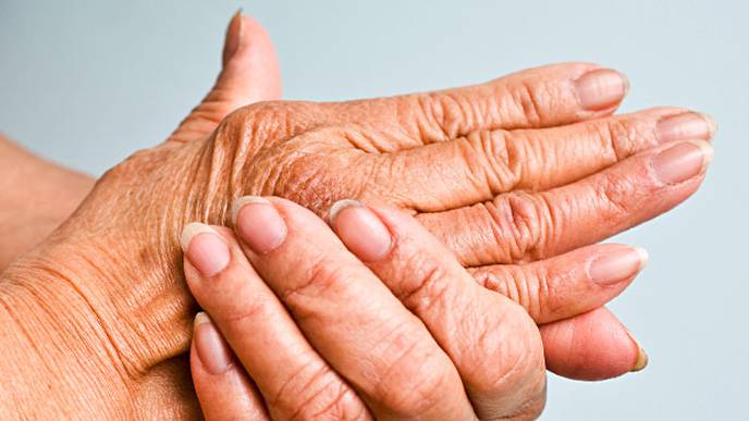 Effect of BMI on Response to Abatacept in Psoriatic Arthritis