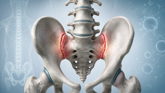 vunakizumab in radiographic axial spondyloarthritis trial