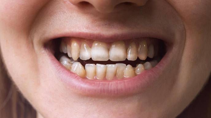 Having These Marks on Teeth Could Point to This Autoimmune Disorder