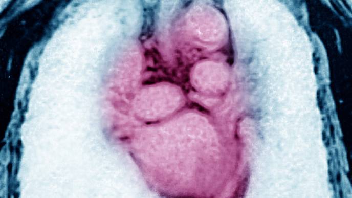 CV Events, Lipid Level Changes Following Tofacitinib Exposure in PsA