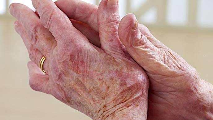 Research Opens the Door to Better Understanding of Osteoarthritis