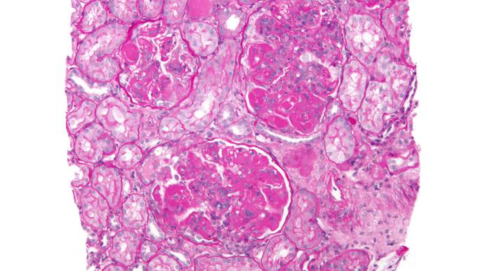 Blood-Clotting Proteins in Urine Discovered as Biomarkers of Lupus Nephritis