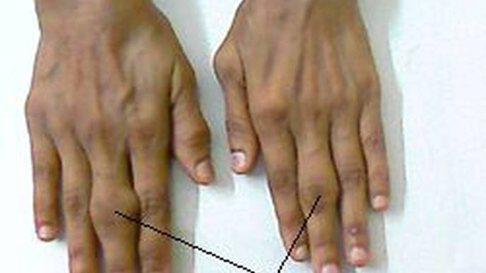 New Option for Treating Active Rheumatoid Arthritis