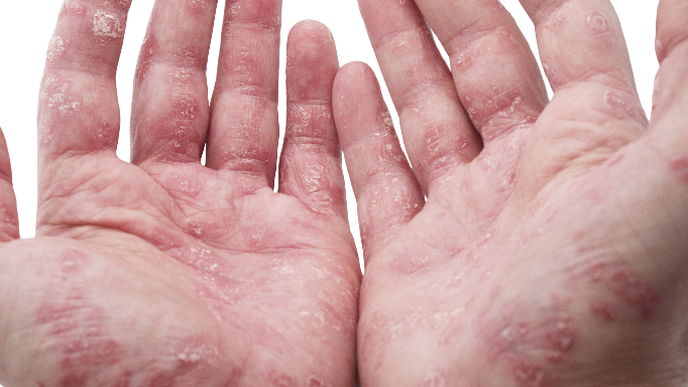 High Prevalence of Neuropathic-Like Pain in Psoriatic Arthritis