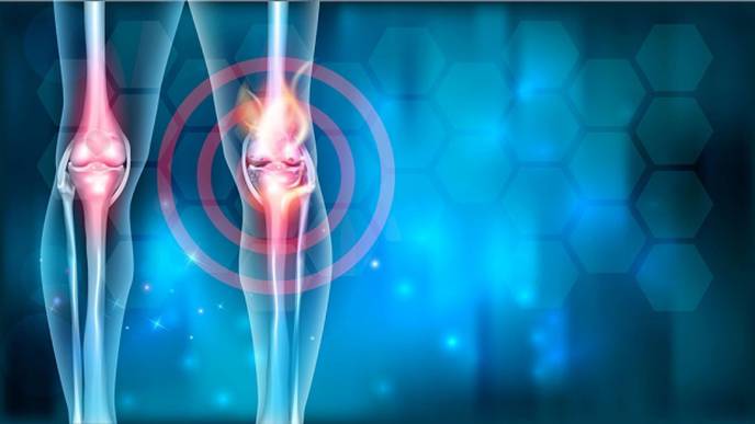 Mast Cells Crucial to Causing Osteoarthritis
