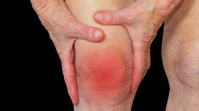 IBD & Type I Diabetes Increase Chances of Developing Rheumatoid Arthritis