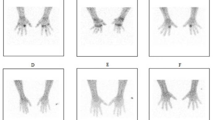 Novel Noninvasive Molecular Imaging for Monitoring Rheumatoid Arthritis